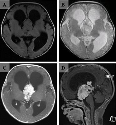 Microscopic and endoscopic “chopstick” technique removal of choroid plexus papilloma in the third ventricle of an infant: a case report with systematic review of literature